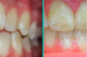 Before and after orthodontic treatment