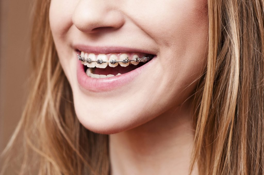 Why Do People Still Go with Traditional Braces? – Coral Springs, FL