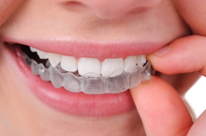 A Clearer Alternative to Traditional Braces
