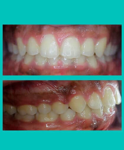 anterior-crossbite-treatment-image-after