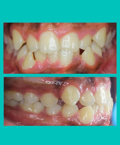 anterior-crossbite-treatment-image-before