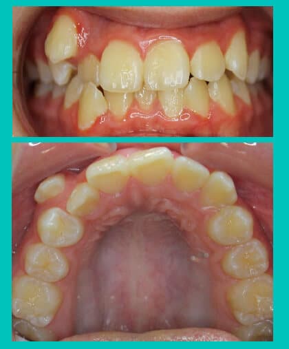 dental-crowding-image-before-coral-springs-fl