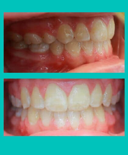 excess-overjet-treatment-image-coral-springs-fl-after