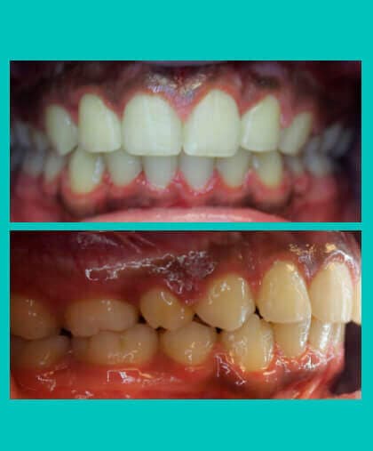 excess-overjet-treatment-bucked-teeth-image-after