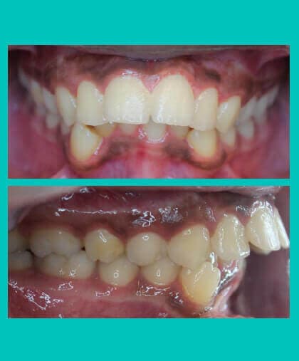 excess-overjet-treatment-bucked-teeth-image-before