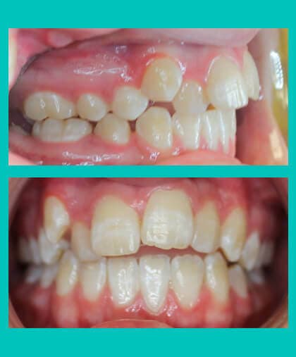 excess-overjet-treatment-image-coral-springs-fl-before