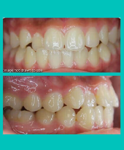 malaligned-teeth-treatment-image-coral-springs-fl-before