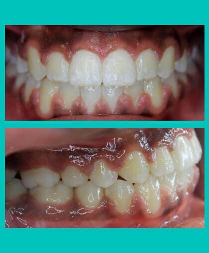 open-bite-treatment-image-coral-springs-fl-after