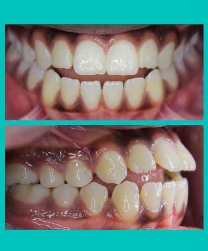 open-bite-treatment-image-coral-springs-fl-before