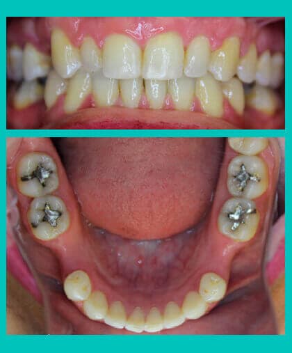 pre-prosethetic-orthodontics-image-coral-springs-fl-after